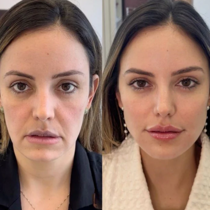 FibraGlow Facial Rejuvenation Massager